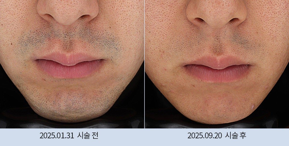 스노우의원 다산점 레이저 제모 전후