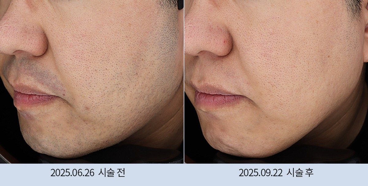 스노우의원 다산점 레이저 제모 전후