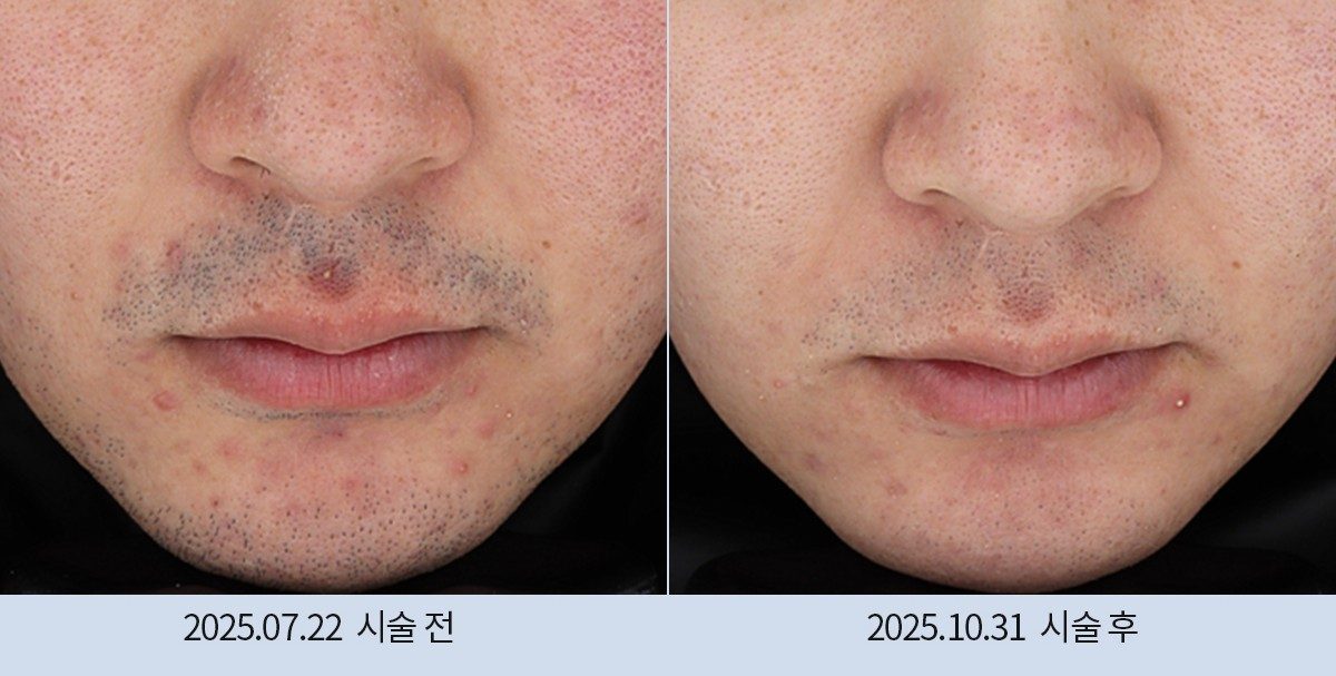 스노우의원 다산점 레이저 제모 전후